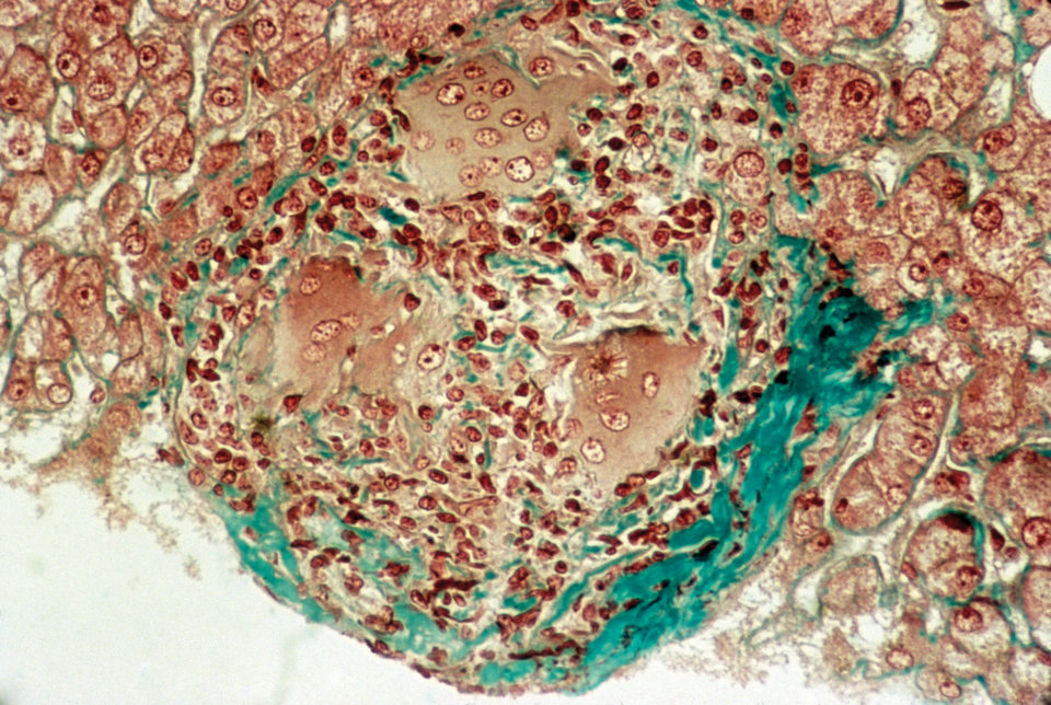 Granulome finden sich häufig auch in der Leber. Sie enthalten Epitheloid- und Riesenzellen.