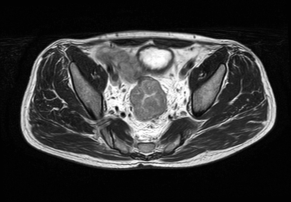 Mit einer MRT lässt sich die Infiltrationstiefe gut beurteilen. Dieses Rektumkarzinom ist bis in das perirektale Fettgewebe eingedrungen. Es handelt sich also um einen T3-Tumor.