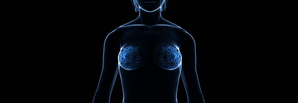 Eine zunehmende Zahl von Personen, die durch eine Genvariante eine erbliche Vorbelastung für die Diagnose Brustkrebs besitzen, lässt sich mittlerweile vorsorglich beide Brüste amputieren. 