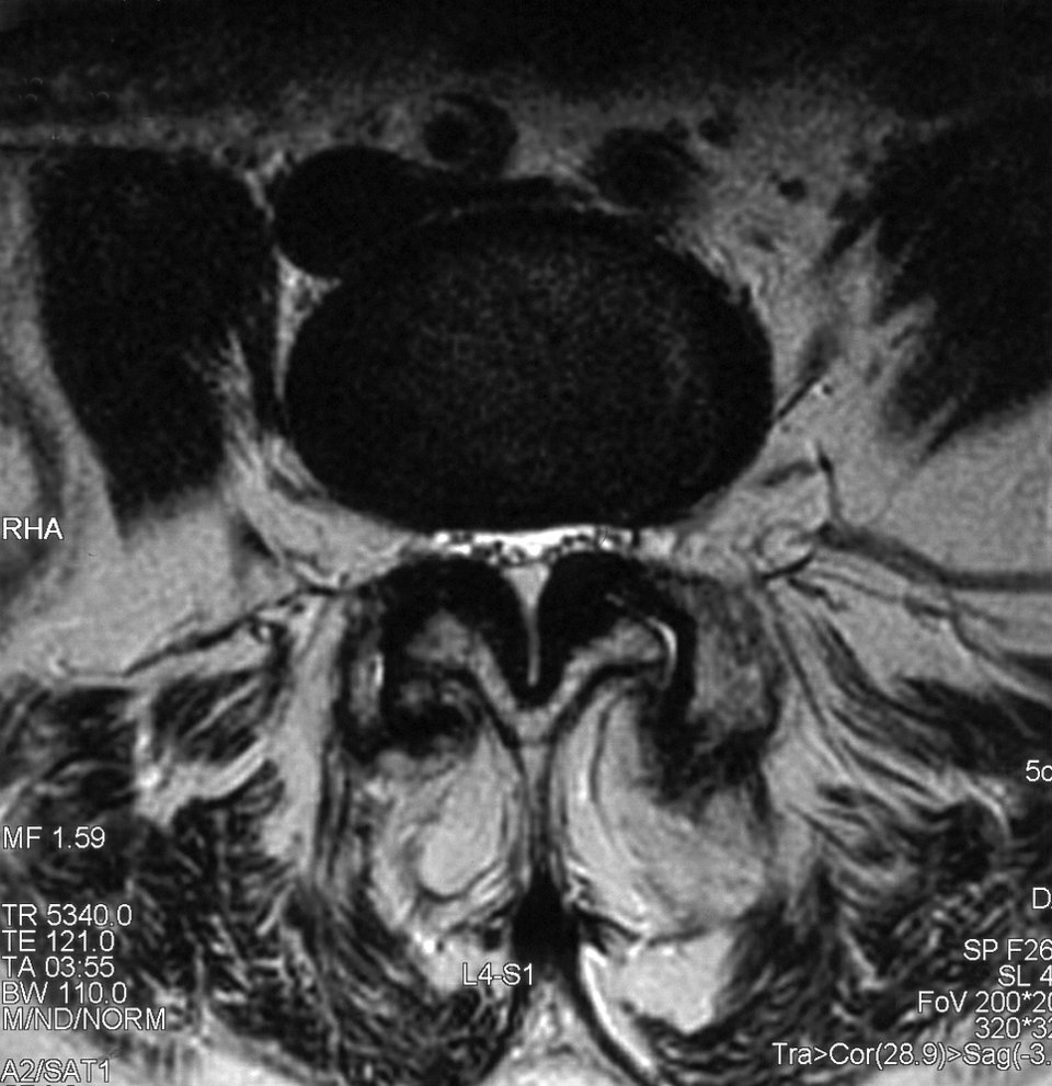 Ausgeprägte Stenose an den Lendenwirbeln 4/5. Das Ligamentum flavum ist beidseitig stark verdickt. Es liegt eine Diskusprotusion vor. Der Duralsack ist eingequetscht.