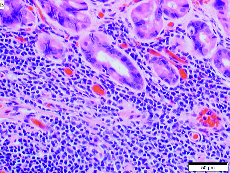 Lymphome in der Magenschleimhaut schreiten meist langsam voran