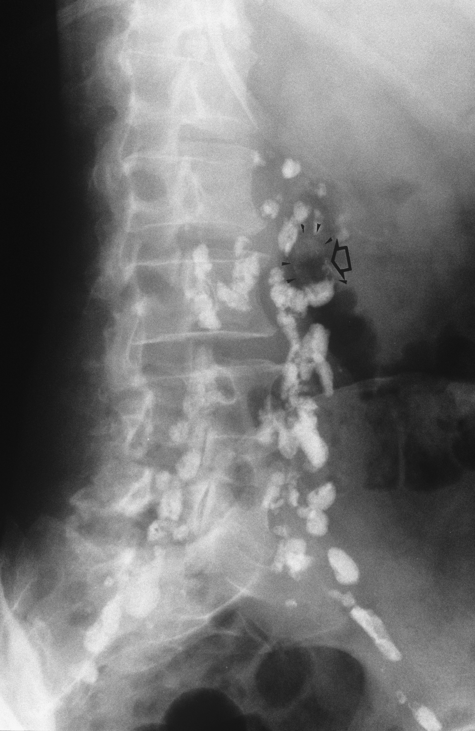 Hodgkin-Lymphome treten v.a. zervikal, axillär und inguinal auf. 