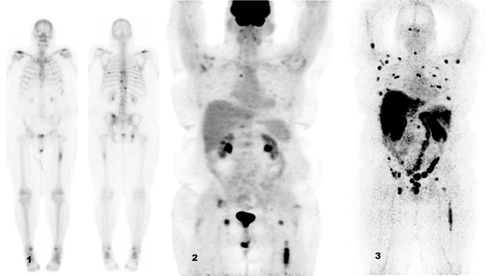 Vergleich der Läsionsdarstellung bei Patienten mit metastasierendem Prostatakarzinom:

(1) Die Knochenszintigraphie mit Technetium-99m-Methylendiphosphonat (Tc-99m-MDP)
zeigt Läsionen in Wirbeln und Rippen.

(2) Der PET-Scan bildet Läsionen im linken Femur und eine Metastase im Wirbel ab.

(3) Das PET/CT mit dem neuen 89Zr-markierten Anti-PSMA-Tracer (Zr-89-IAB2M) macht, im Vergleich zu den beiden anderen Scans, deutlich mehr Läsionen sichtbar.