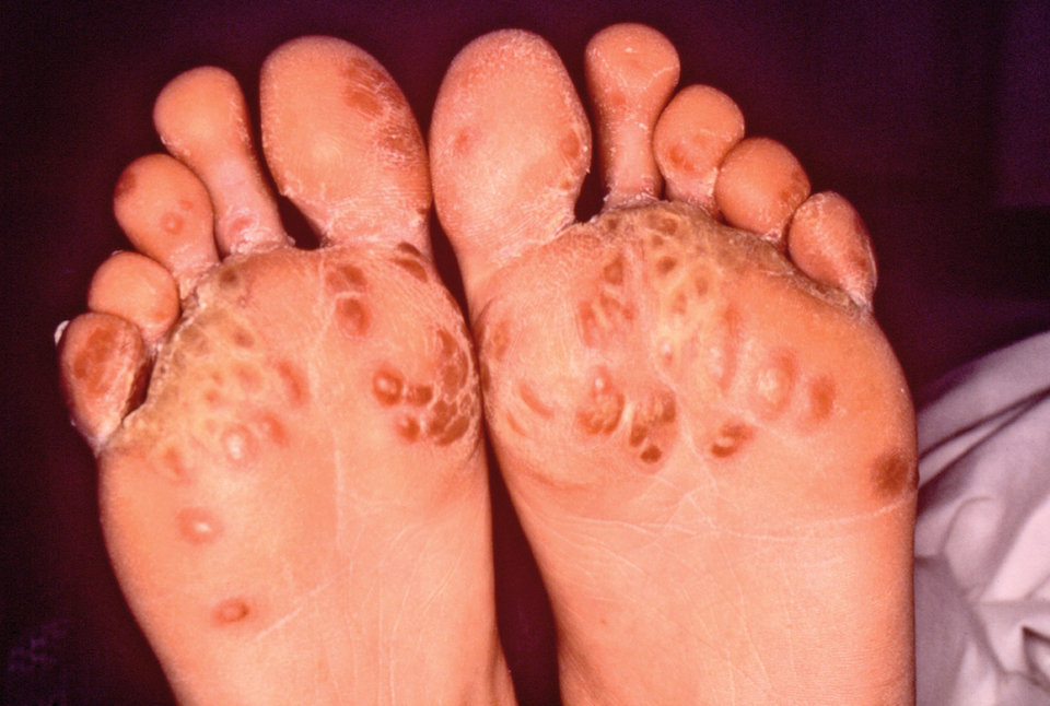 Keratoderma blennorrhagicum als typisches Symptom des Reiter-Syndroms.