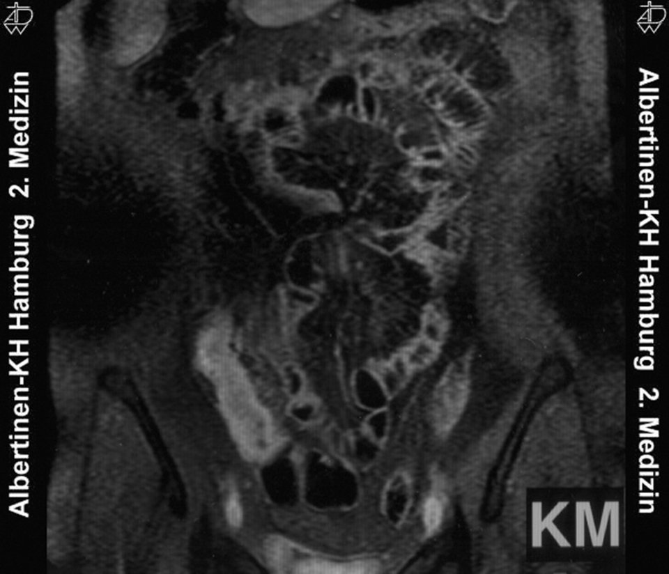 Ein Auslassversuch von Methotrexat endet nicht selten mit einem Rezidiv, so wie hier im terminalen Ileum.