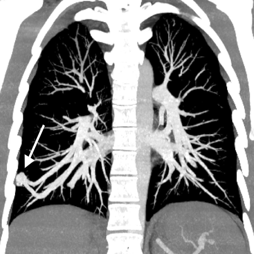 Ein 55-Jähriger mit pulmonalen arteriovenösen Fisteln (s. Pfeil) wurde mit „Stöpseln“ aus Nitinol-Draht behandelt.