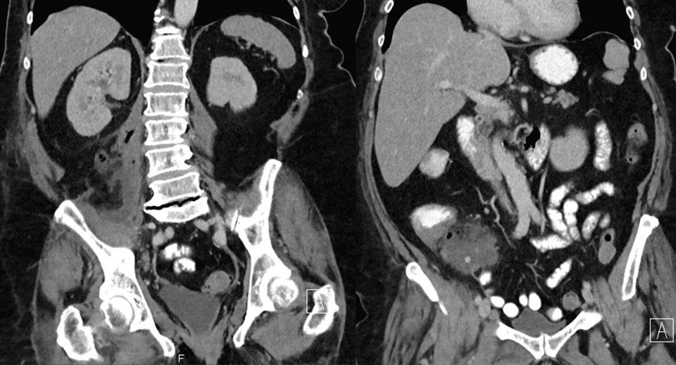 Abszessformation mit Lufteinschlüssen auf dem Psoas (links) sowie entzündliches Konglomerat (rechts) lassen auf eine abszedierte perforierte Appendizitis schließen.