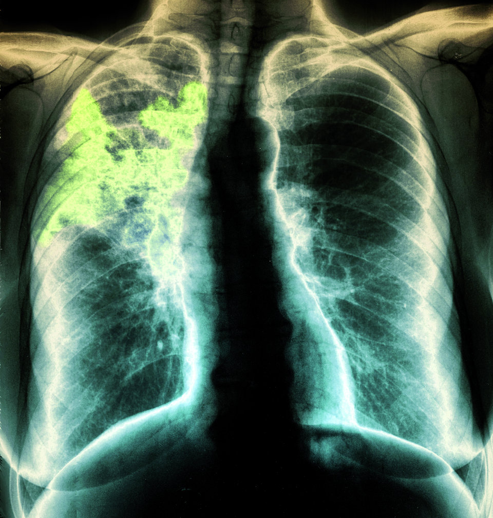 Die Bildgebung sichert die Pneumonie-Diagnose und sollte auch im ambulanten Bereich veranlasst werden.