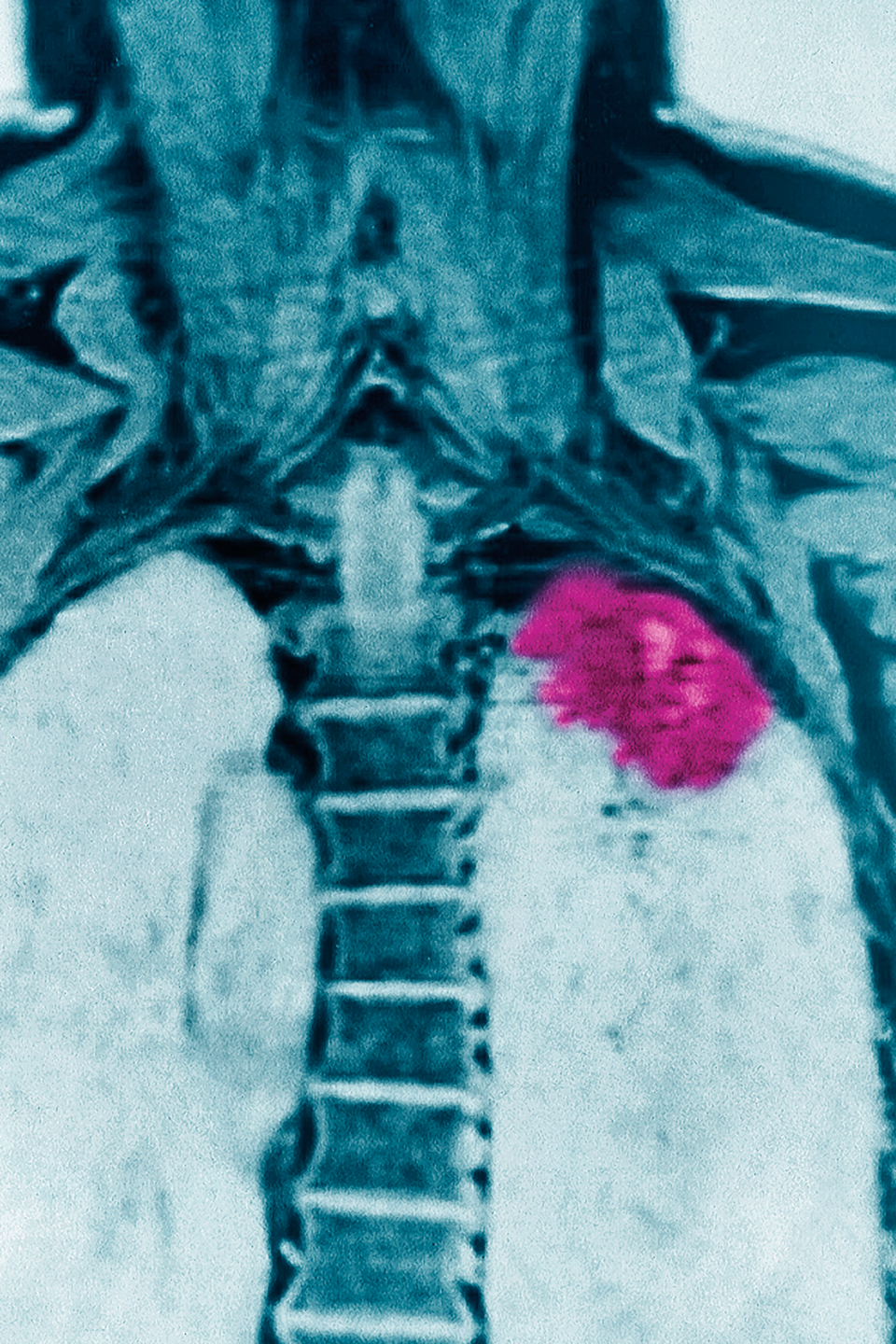 Die Immuntherapie zur Behandlung des NSCLC besteht aus gemeinsamer PD1- und CTLA4-Hemmung.