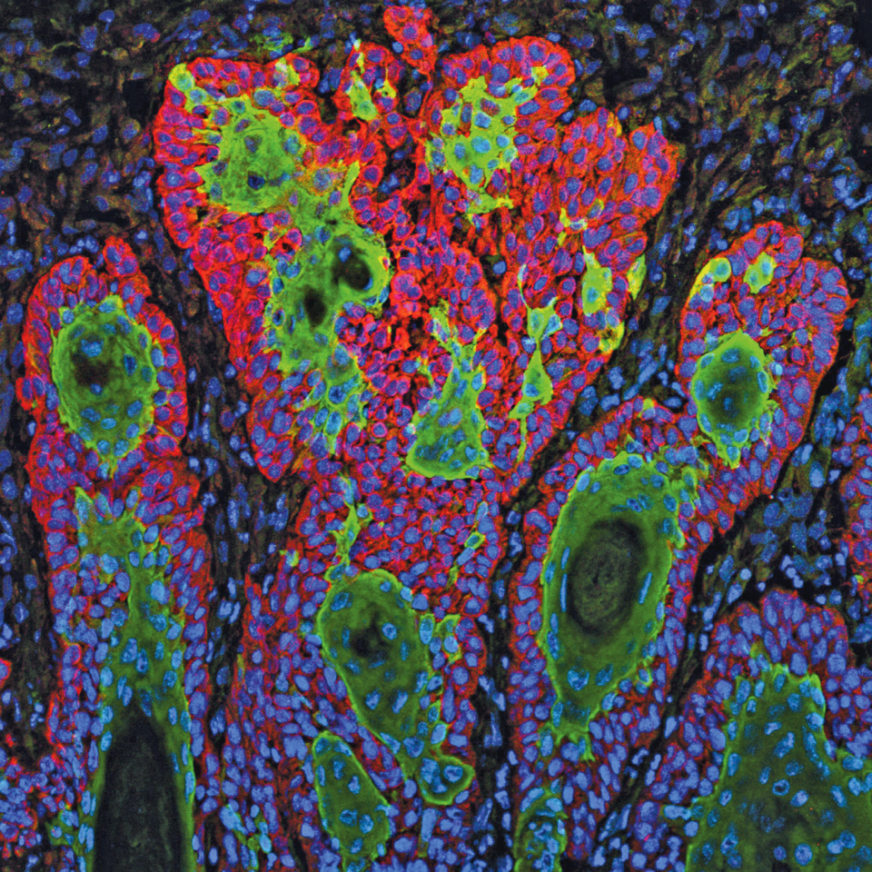 Plattenepithelkarzinome sind die zweithäufigste Form von Hautkrebs. Das HP-Virus könnte bei der Entstehung eine Rolle spielen.