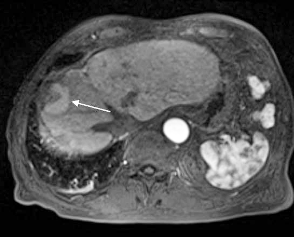 MRT nach erfolgreicher Mikrowellen­ablation