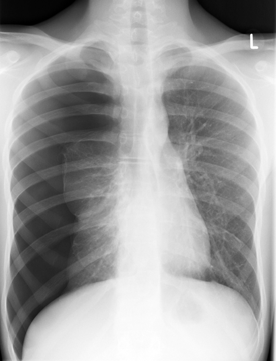 Hier zeigt sich ein fast vollständiger rechtsseitiger Pneumothorax.