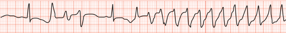 Torsade-de-Pointes-Arrhythmie