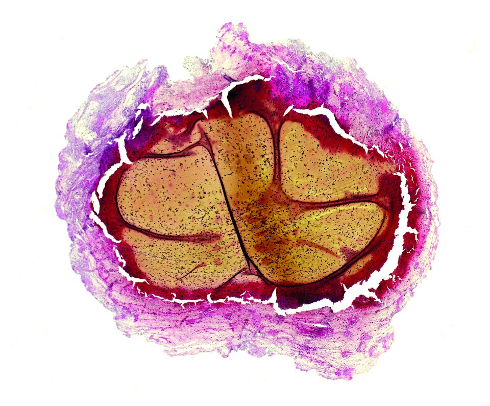 Beim APS können Thrombosen in allen Gefäßen auftreten. Häufig betroffen sind die tiefen Beinvenen.
