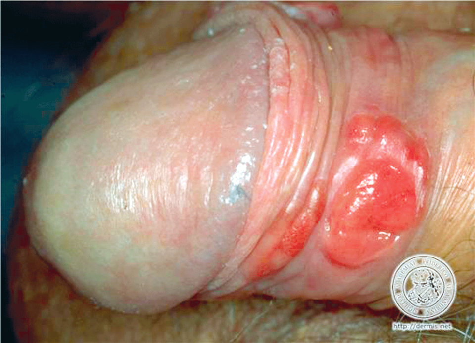 Abbildung 4: Bei Morbus Bowen handelt es sich um ein intraepidermales Carcinoma in situ. 