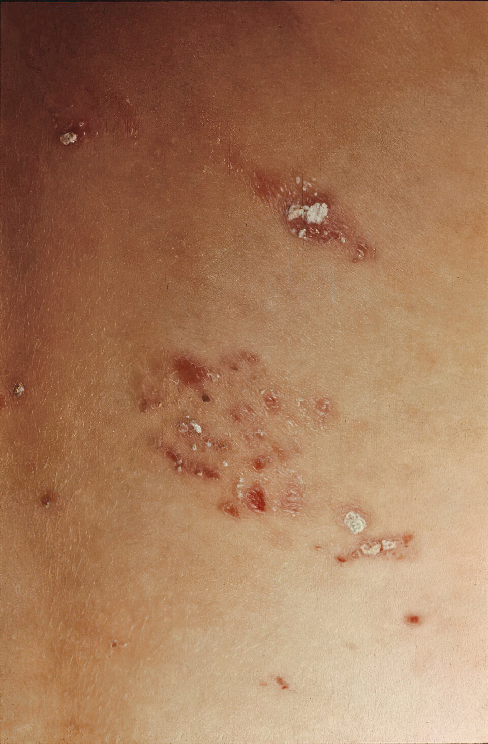 Abb. 1: Dermatitis herpetiformis Duhring 