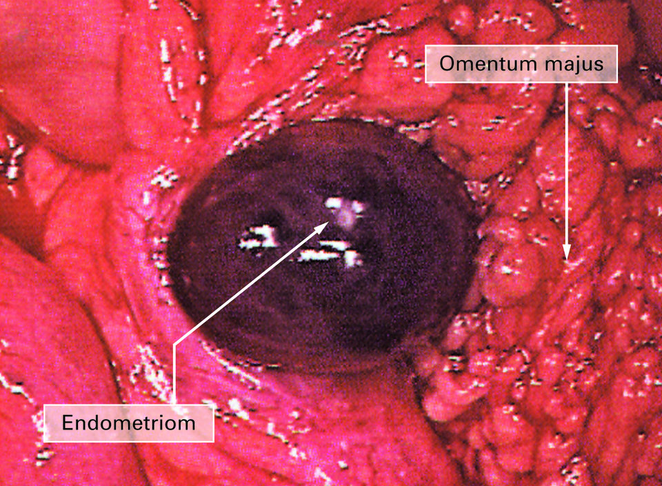 Während des chirurgischen Eingriffs entfernen
Gynäkologen bei dieser Patientin
die Endometriosis extragenitalis abdominalis.