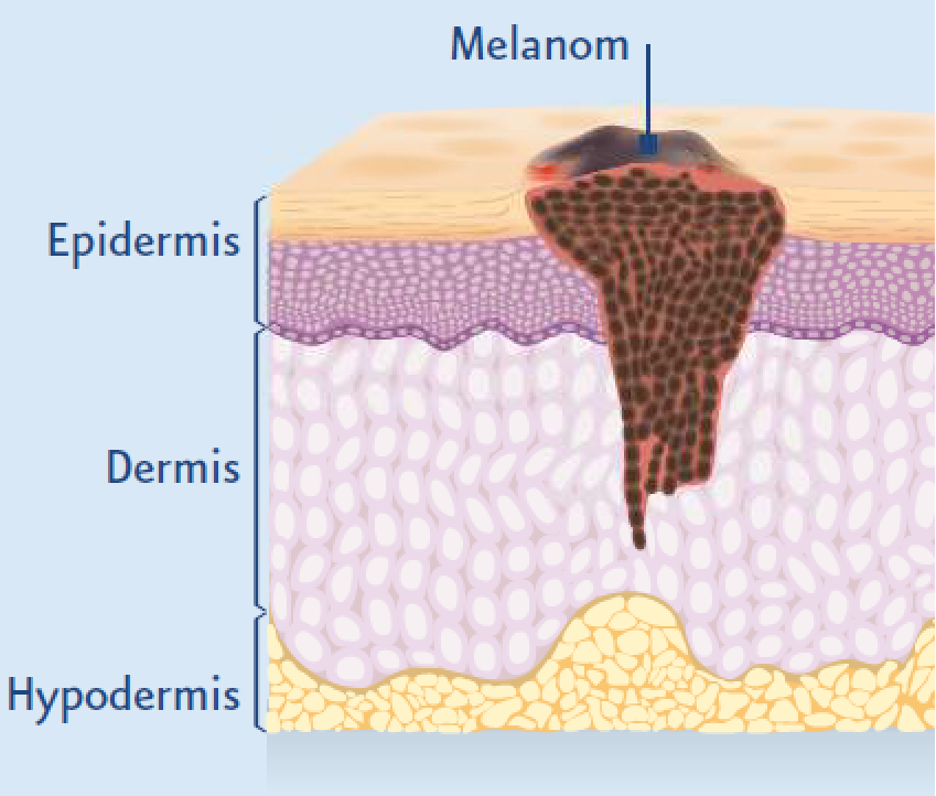 Die verschiedenen Stadien des malignen Melanoms zeigen sich unter anderem in der Eindringtiefe in die Haut.
