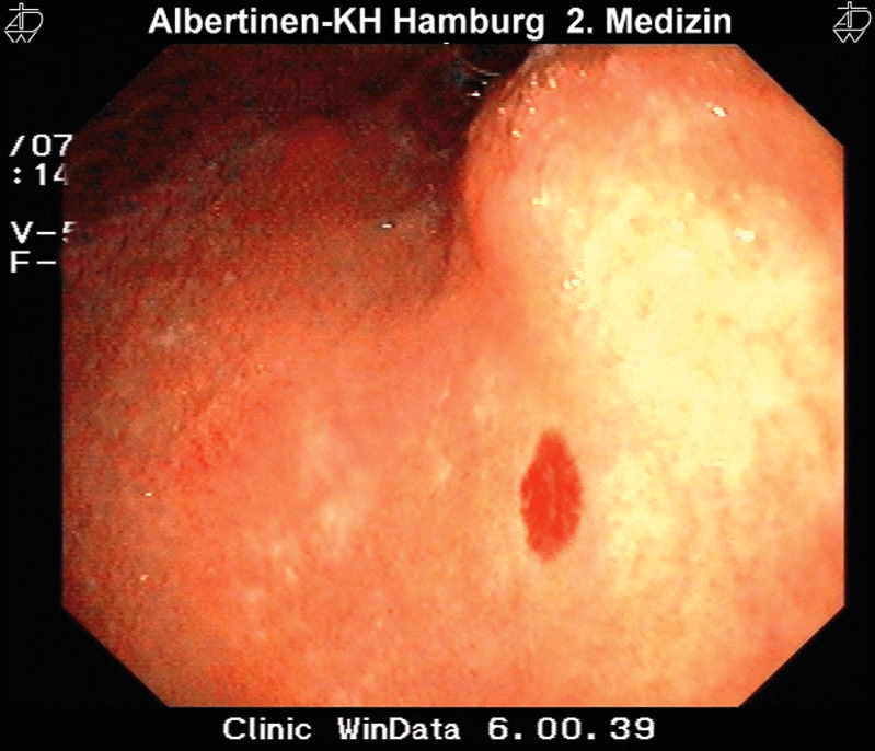 Magenschleimhautblutung aufgrund einer Angiodysplasie.