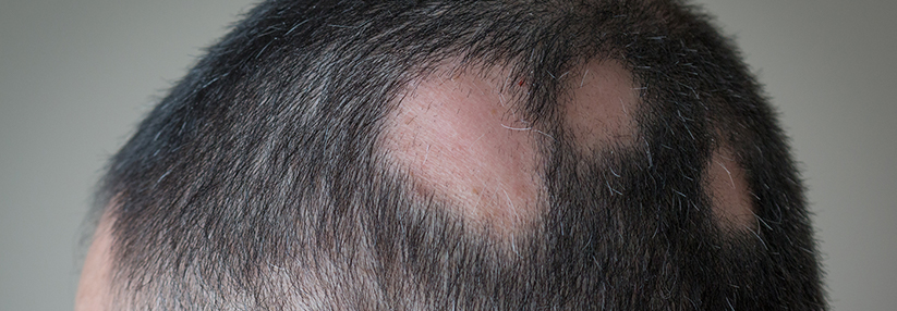 Januskinase Inhibitor Wirkt Gegen Alopecia Areata Medical Tribune