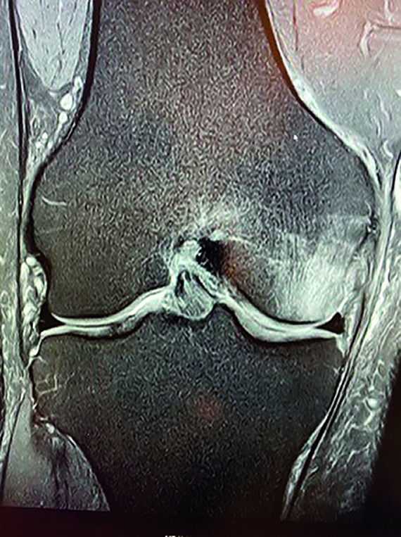 Die Abbildung zeigt ein Knochenmarködemsyndrom, dem eine ausgeprägte lokale transiente Osteoporose zugrunde liegt. Der Patient litt seit fünf Wochen unter belastungsabhängigen Knieschmerzen. Ein Jahr zuvor hatte er vorübergehend Sprunggelenkbeschwerden.