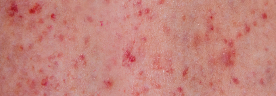 Punktförmige Hautblutungen (Petechien) sprechen für eine thrombozytäre Störung.