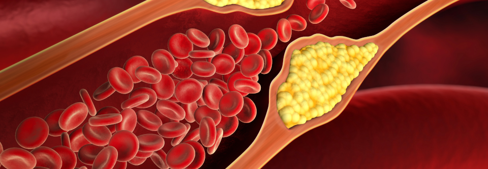 In Studien an nicht-humanen Primaten konnte die PCSK9-Konzentration durch die Gentherapie für ein Jahr um mehr als 80 % und das LDL-Cholesterin um 70 % gesenkt werden.