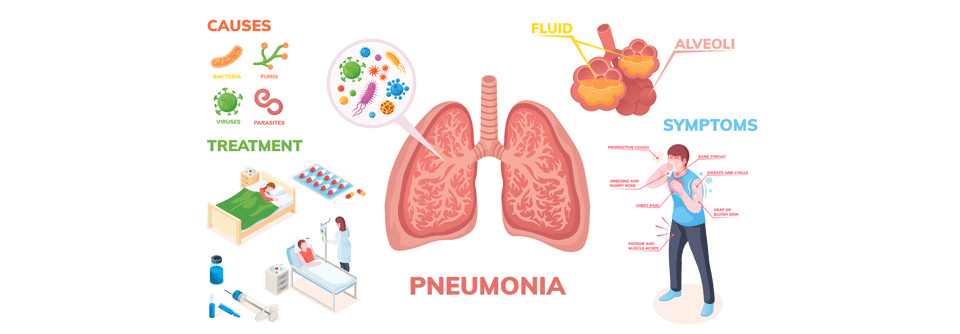 Menschen mit einer schweren ambulant erworbenen Pneumonie profitieren offenbar von einer frühzeitigen intravenösen Behandlung mit Hydrokortison.